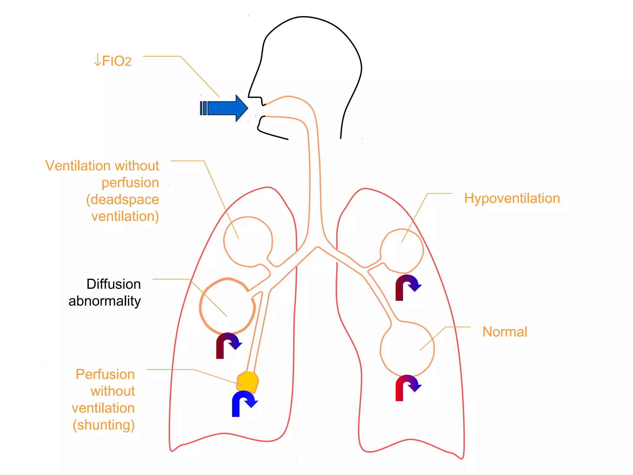 ↓FIO2
Ventilation without
perfusion
(deadspace
ventilation)
Diffusion
abnormality
Perfusion
without
ventilation
(shunting)
Hypoventilation
Normal
 