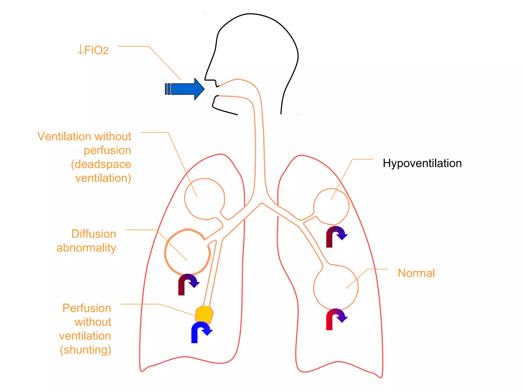 ↓FIO2
Ventilation without
perfusion
(deadspace
ventilation)
Diffusion
abnormality
Perfusion
without
ventilation
(shunting)
Hypoventilation
Normal
 