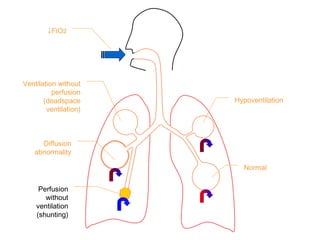 ↓FIO2
Ventilation without
perfusion
(deadspace
ventilation)
Diffusion
abnormality
Perfusion
without
ventilation
(shunting)
Hypoventilation
Normal
 