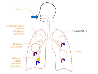 ↓FIO2
Ventilation without
perfusion
(deadspace
ventilation)
Diffusion
abnormality
Perfusion
without
ventilation
(shunting)
Hypoventilation
Normal
 