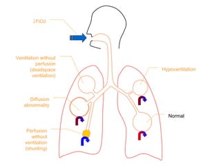 ↓FIO2
Ventilation without
perfusion
(deadspace
ventilation)
Diffusion
abnormality
Perfusion
without
ventilation
(shunting)
Hypoventilation
Normal
 