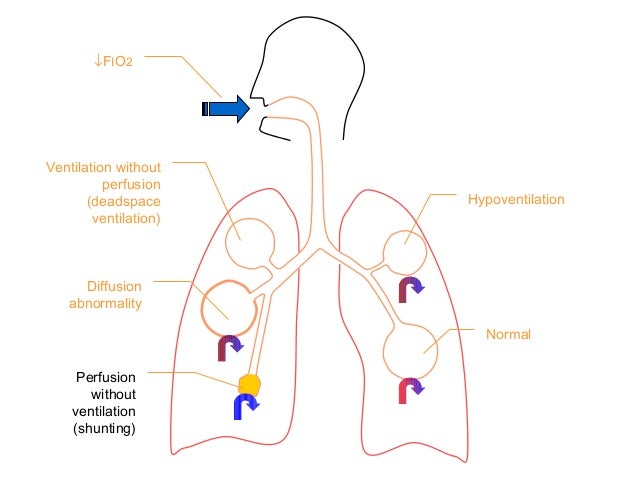 Assessing the need for mechanical ventilation