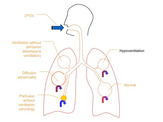 Assessing the need for mechanical ventilation