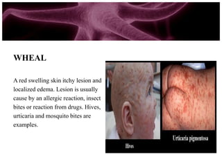 Wheals Examples Assessing the skin | PPTX