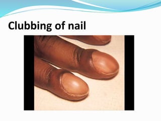 Nail Clubbing Algorithm Assessment and diagnostic evaluation of integumentary system | PPTX
