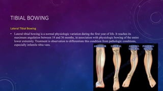 Tibia Anguation Assessment and evaluation tools for pediatric and acquired congenital ...