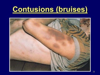 35
Contusions (bruises)
 