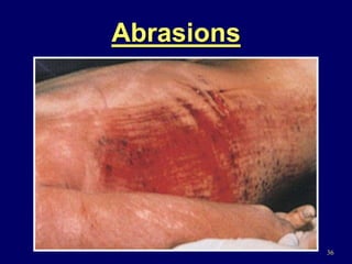 36
Abrasions
 