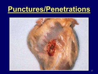 37
Punctures/Penetrations
 