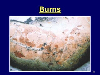 38
Burns
 