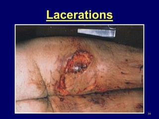 39
Lacerations
 