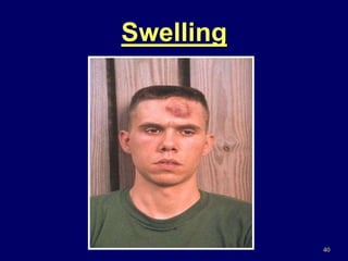 40
Swelling
 