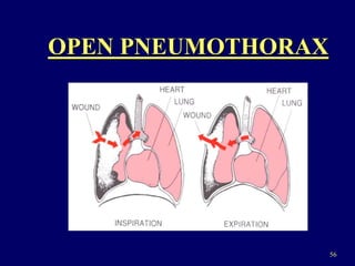 56
OPEN PNEUMOTHORAX
 