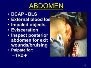 60
• DCAP - BLS
• External blood loss
• Impaled objects
• Evisceration
• Inspect posterior
abdomen for exit
wounds/bruising
• Palpate for:
–TRD-P
ABDOMEN
 