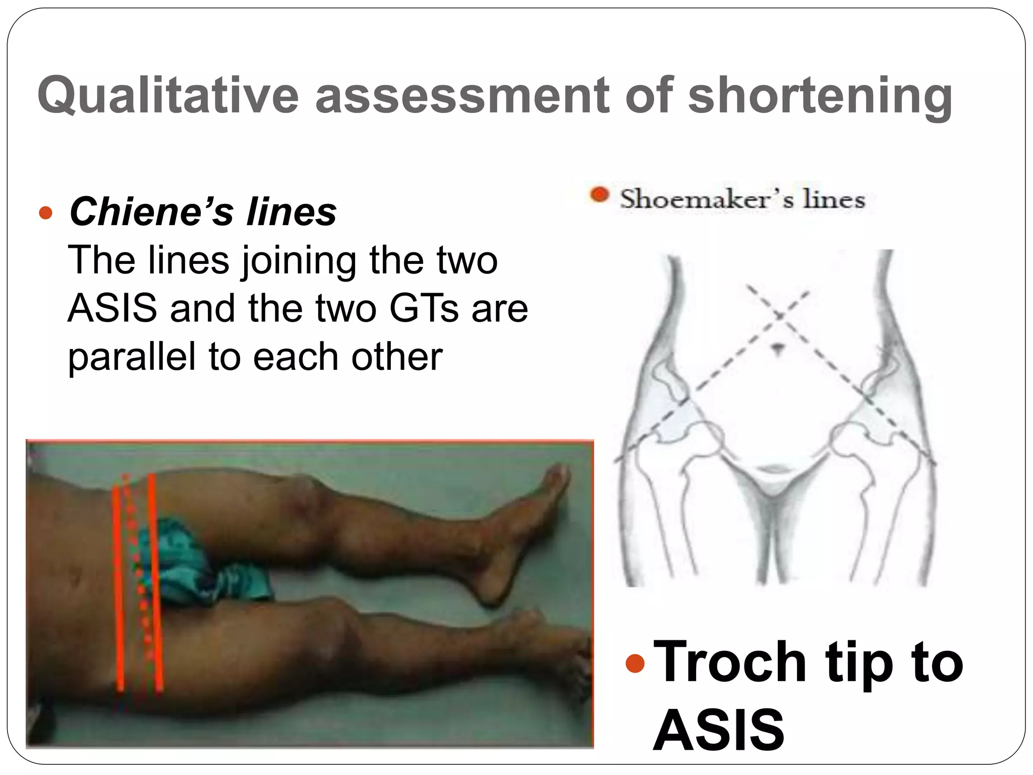 Assessment and special tests of Hip joint | PPTX