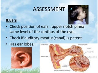 ASSESSMENT
8.Ears
• Check position of ears : upper notch pinna
  same level of the canthus of the eye.
• Check if auditory meatus(canal) is patent.
• Has ear lobes
 