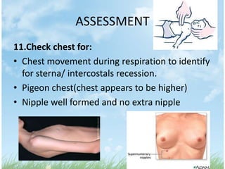 ASSESSMENT
11.Check chest for:
• Chest movement during respiration to identify
  for sterna/ intercostals recession.
• Pigeon chest(chest appears to be higher)
• Nipple well formed and no extra nipple
 