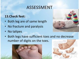 ASSESSMENT
13.Check feet:
• Both leg are of same length
• No fracture and paralysis
• No talipes
• Both legs have sufficient toes and no decrease
  number of digits on the toes.
 