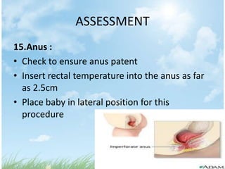 ASSESSMENT
15.Anus :
• Check to ensure anus patent
• Insert rectal temperature into the anus as far
  as 2.5cm
• Place baby in lateral position for this
  procedure
 