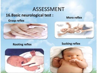 ASSESSMENT
16.Basic neurological test :      Moro reflex
 Grasp reflex




    Rooting reflex             Sucking reflex
 