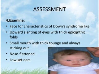 ASSESSMENT
4.Examine:
• Face for characteristics of Down’s syndrome like:
• Upward slanting of eyes with thick epicqnthic
  folds
• Small mouth with thick tounge and always
  sticking out
• Nose-flattened
• Low set ears
 