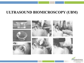 ULTRASOUND BIOMICROSCOPY (UBM)
 