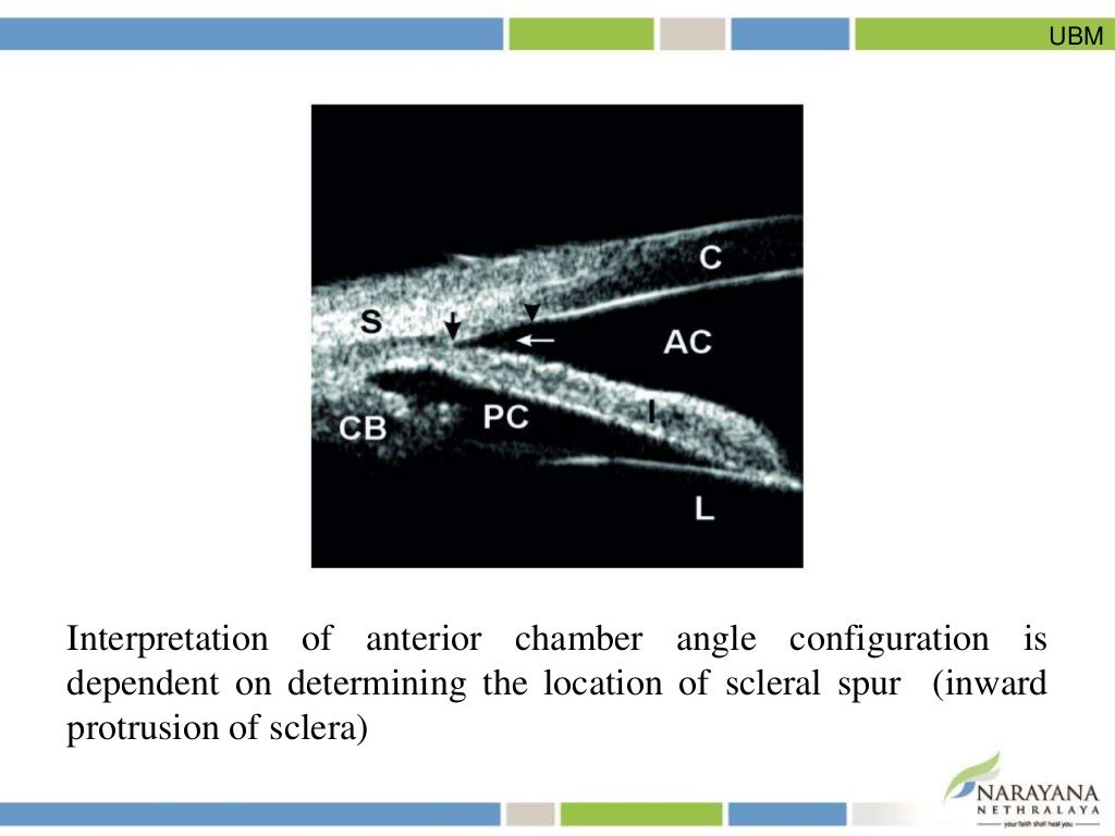 Assessment of Anterior Chamber Angle