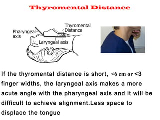 Short Distance Range Structure Short Thyromental Distance Range – ICPP