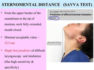 Sternomental Distance
