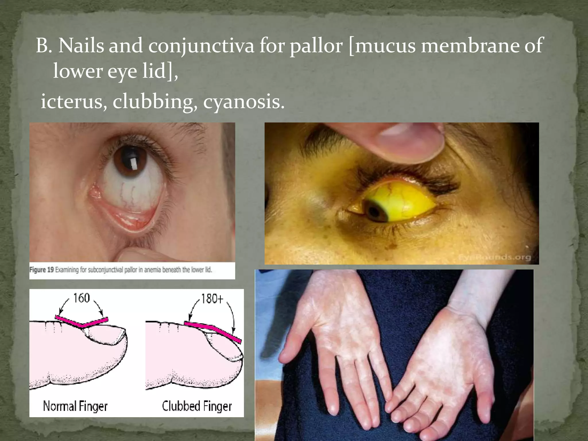 B. Nails and conjunctiva for pallor [mucus membrane of
lower eye lid],
icterus, clubbing, cyanosis.
 