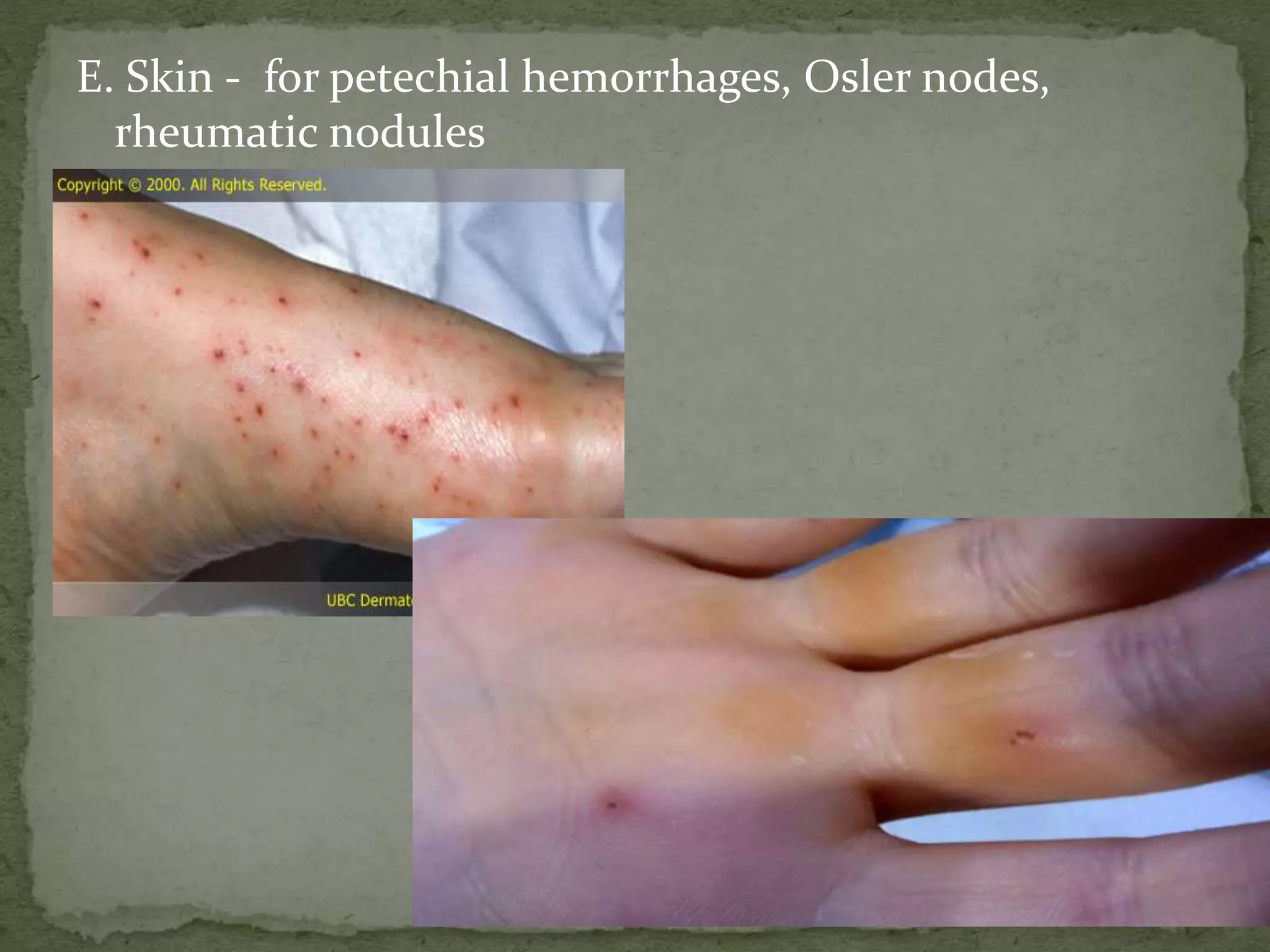 E. Skin - for petechial hemorrhages, Osler nodes,
rheumatic nodules
 