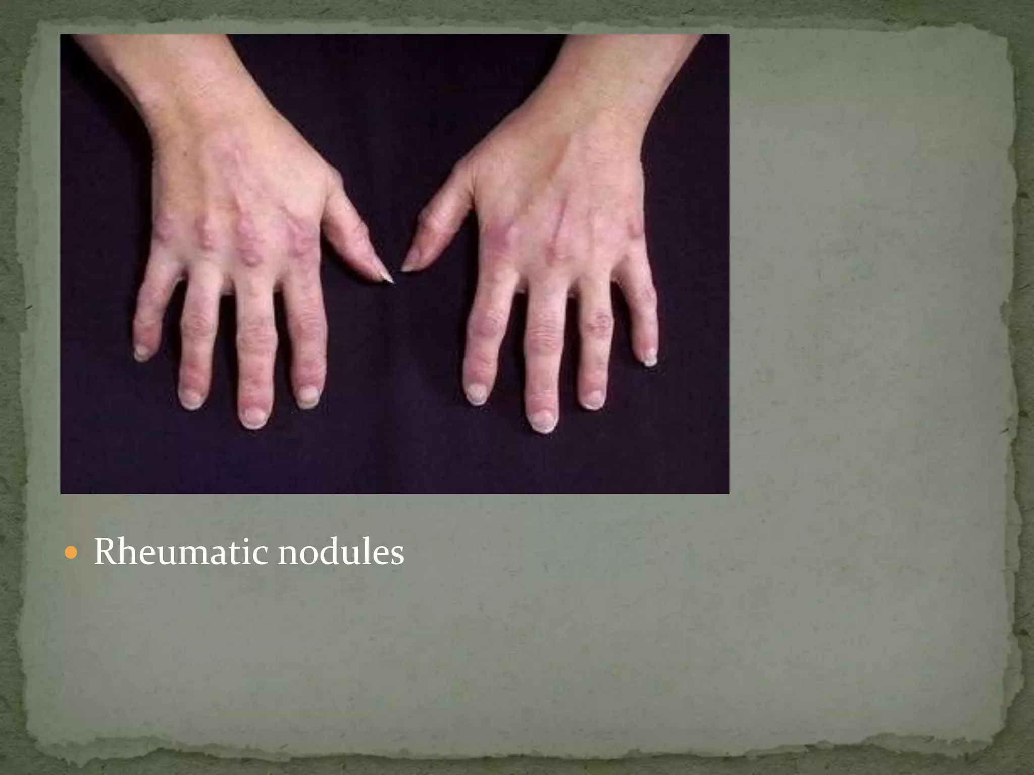  Rheumatic nodules
 