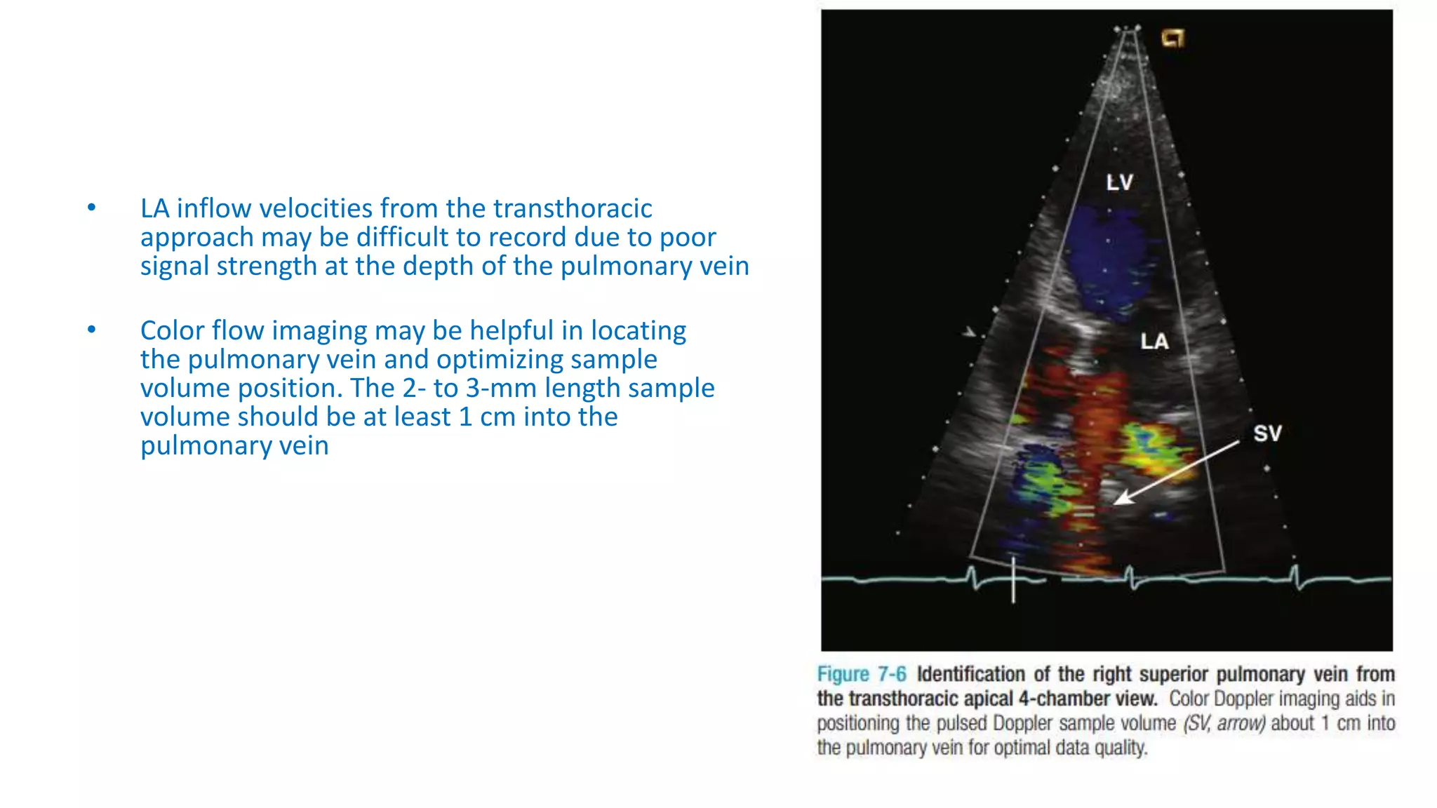 • LA inflow velocities from the transthoracic
approach may be difficult to record due to poor
signal strength at the depth of the pulmonary vein
• Color flow imaging may be helpful in locating
the pulmonary vein and optimizing sample
volume position. The 2- to 3-mm length sample
volume should be at least 1 cm into the
pulmonary vein
 