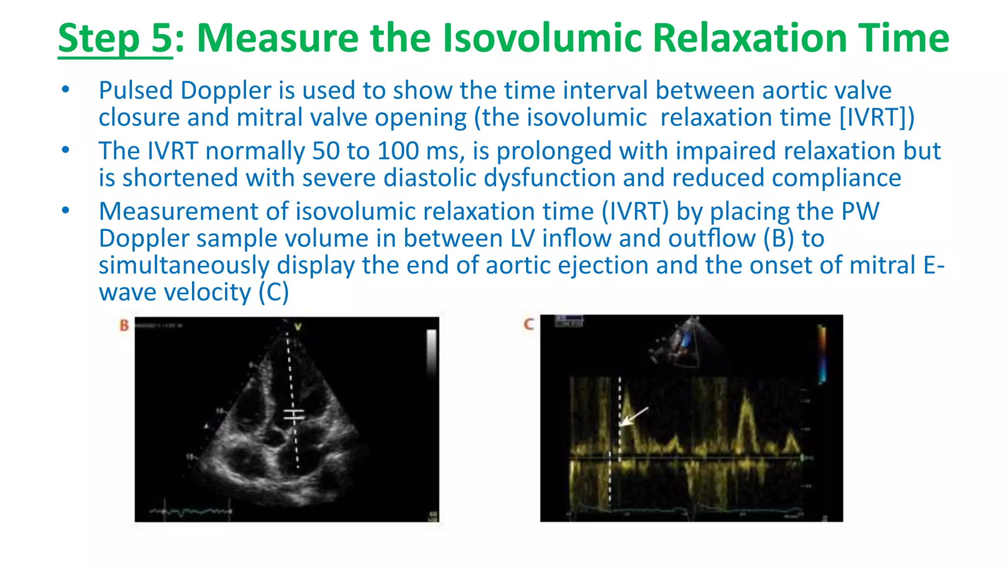 Step 5: Measure the Isovolumic Relaxation Time
• Pulsed Doppler is used to show the time interval between aortic valve
closure and mitral valve opening (the isovolumic relaxation time [IVRT])
• The IVRT normally 50 to 100 ms, is prolonged with impaired relaxation but
is shortened with severe diastolic dysfunction and reduced compliance
• Measurement of isovolumic relaxation time (IVRT) by placing the PW
Doppler sample volume in between LV inﬂow and outﬂow (B) to
simultaneously display the end of aortic ejection and the onset of mitral E-
wave velocity (C)
 