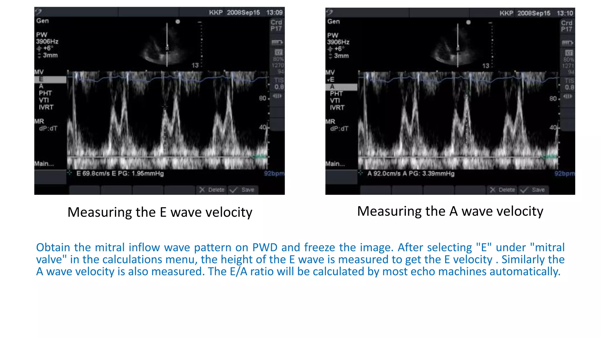 Measuring the E wave velocity
Obtain the mitral inflow wave pattern on PWD and freeze the image. After selecting "E" under "mitral
valve" in the calculations menu, the height of the E wave is measured to get the E velocity . Similarly the
A wave velocity is also measured. The E/A ratio will be calculated by most echo machines automatically.
Measuring the A wave velocity
 
