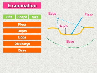 Edge Depth Assessment of DM and diabetic foot | PPTX