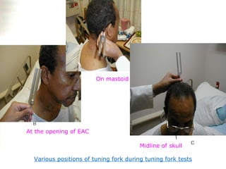 Various positions of tuning fork during tuning fork tests On mastoid At the opening of EAC Midline of skull 
