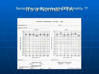 It’s a Normal PTA Sensorineuronal/conductive abnormality ?? 