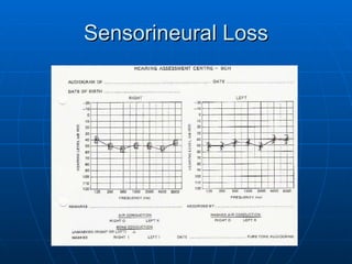 Sensorineural Loss 