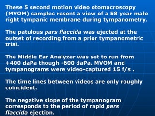 These 5 second motion video otomacroscopy (MVOM) samples resent a view of a 58 year male right tympanic membrane during tympanometry. The patulous  pars flaccida  was ejected at the outset of recording from a prior tympanometric trial. The Middle Ear Analyzer was set to run from +400 daPa though -600 daPa. MVOM and tympanograms were video-captured 15 f/s . The time lines between videos are only roughly coincident. The negative slope of the tympanogram corresponds to the period of rapid  pars flaccida  ejection. 