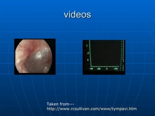 videos Taken from--- http:// www.rcsullivan.com/www/tympavi.htm   