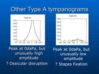 Other Type A tympanograms Peak at 0daPa, but unusually high amplitude ? Ossicular disruption Peak at 0daPa, but unusually low amplitude ? Stapes fixation 