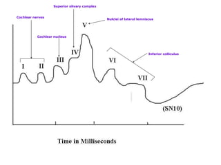 Cochlear nerves   Cochlear nucleus   Superior olivary complex   Nulclei of lateral lemniscus     Inferior colliculus    