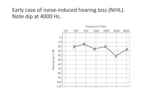 ASSESSMENT OF HEARING | PPT