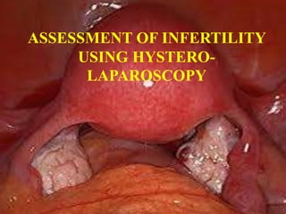 ASSESSMENT OF INFERTILITY
USING HYSTERO-
LAPAROSCOPY
 