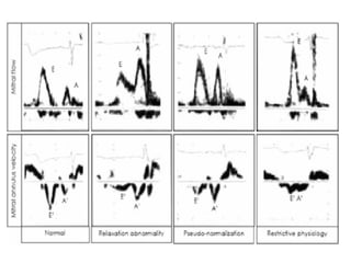 ASSESSMENT OF LEFT VENTRICULAR DIASTOLIC FUNCTION seminar 2.pptx