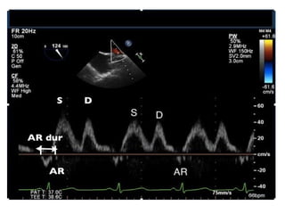 ASSESSMENT OF LEFT VENTRICULAR DIASTOLIC FUNCTION seminar 2.pptx