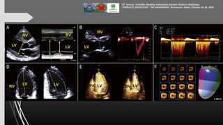 Assessment of Left Ventricular Function by Echocardiography 25 Okt 24...pdf