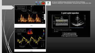 Assessment of Left Ventricular Function by Echocardiography 25 Okt 24...pdf