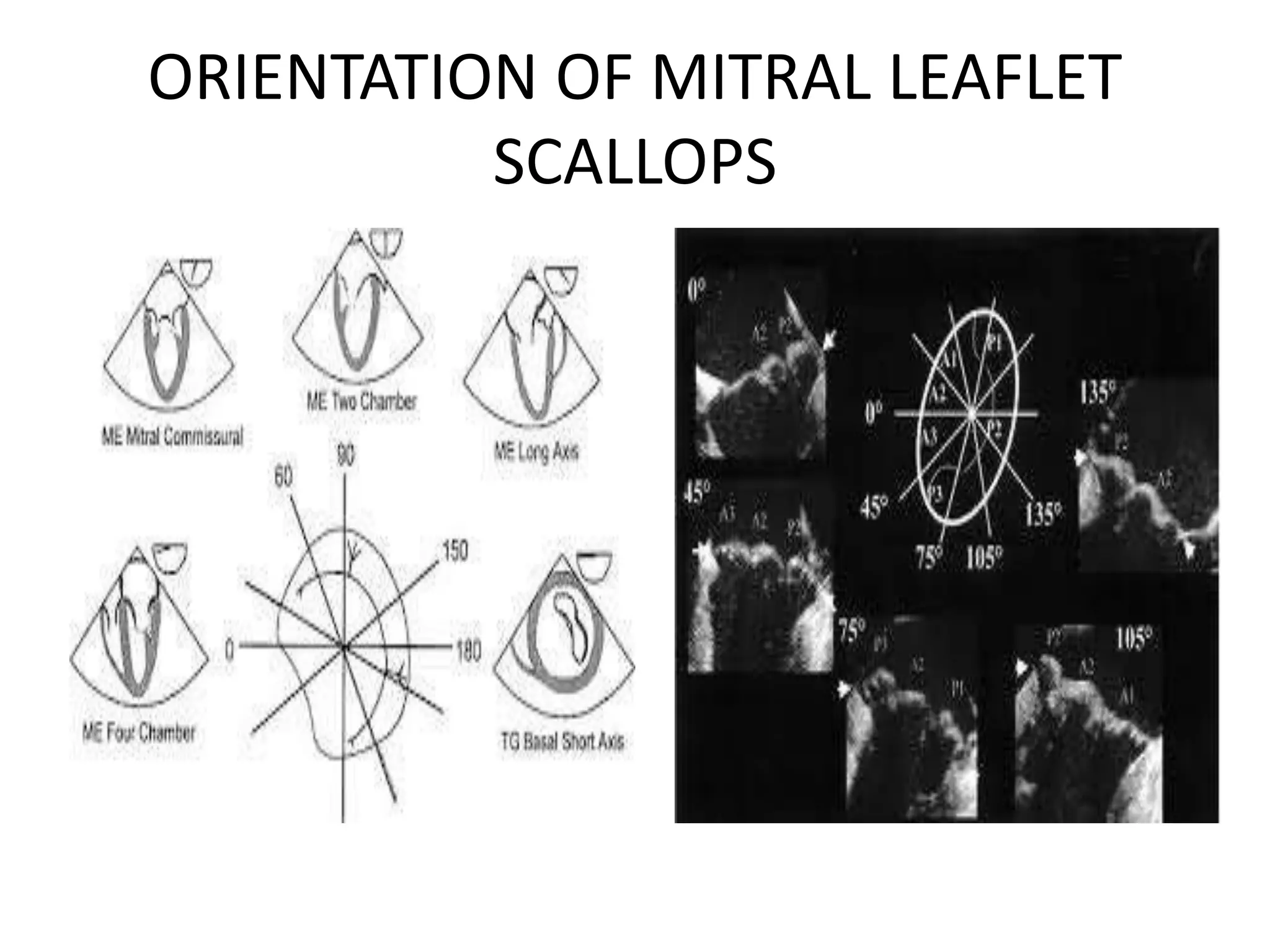 Assessment of mitral valve by TEE | PPTX
